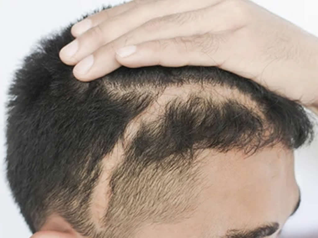 FUE.one Hair Transplants in Scars and Burns