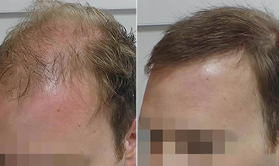 2000 grafts/FUE hair transplant