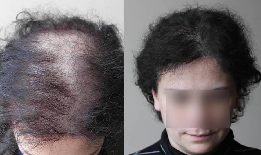 FUE.one Hair Transplants. Before & After
