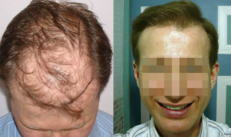 FUE.one Hair Transplants. Before & After