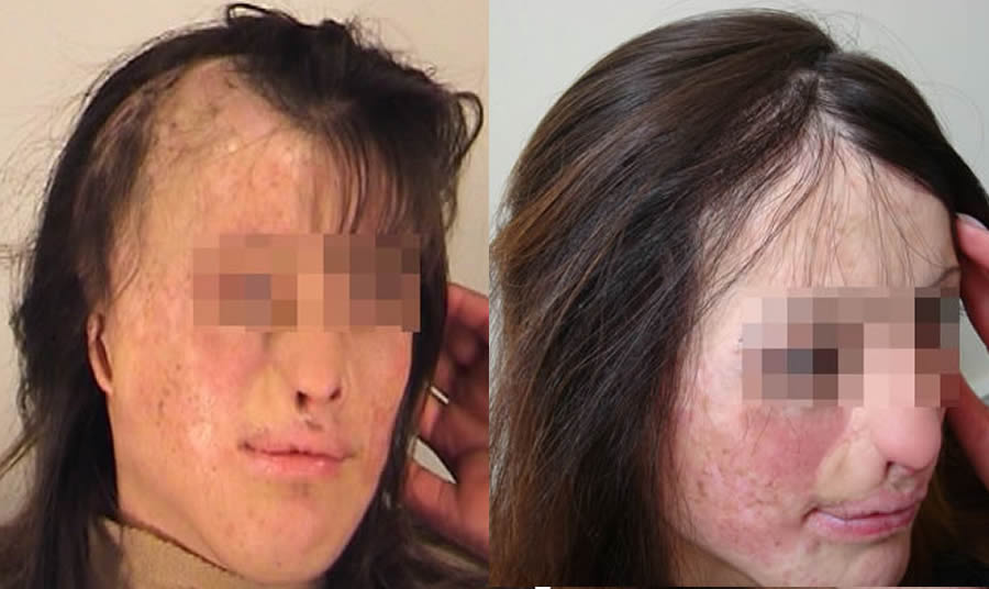 Hair Restoration in Scars & Burns