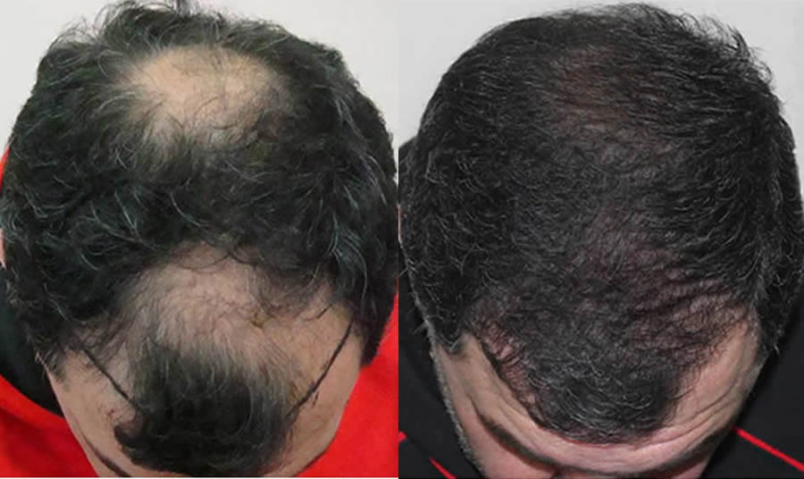 FUE.one Hair Transplants. Before & After