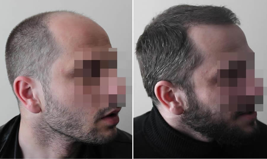 FUE.one Hair Transplants. Before & After