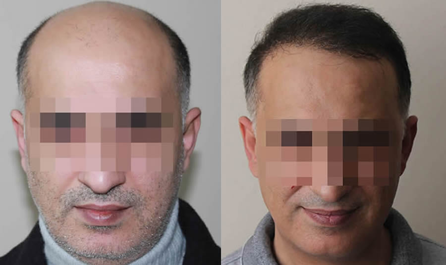 FUE.one Hair Transplants. Before & After