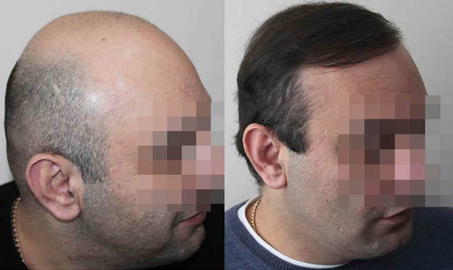 FUE.one Hair Transplants. Before & After