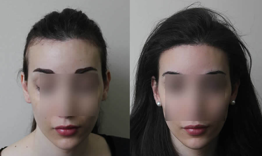Woman Hair Transplants. Before & After